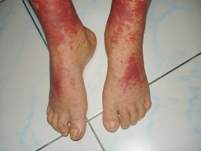 Vasculitis of legs and feet